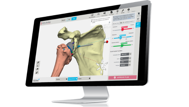 Computer monitor showing the TRUMATCH personalized solutions shoulder system interface on the screen 