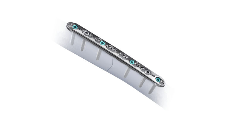 VOLT Straight Plate on bone with screws