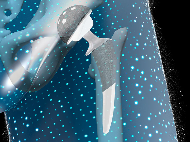 VELYS Enabling Tech with ACTIS and EMPHASYS Implants for THA