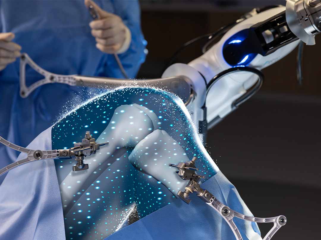 VELYS Robotic-Assisted Technology for UKA Procedures