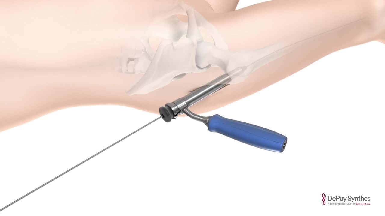 TFN-ADVANCED™ Proximal Femoral Nailing System (TFNA) | DePuy Synthes