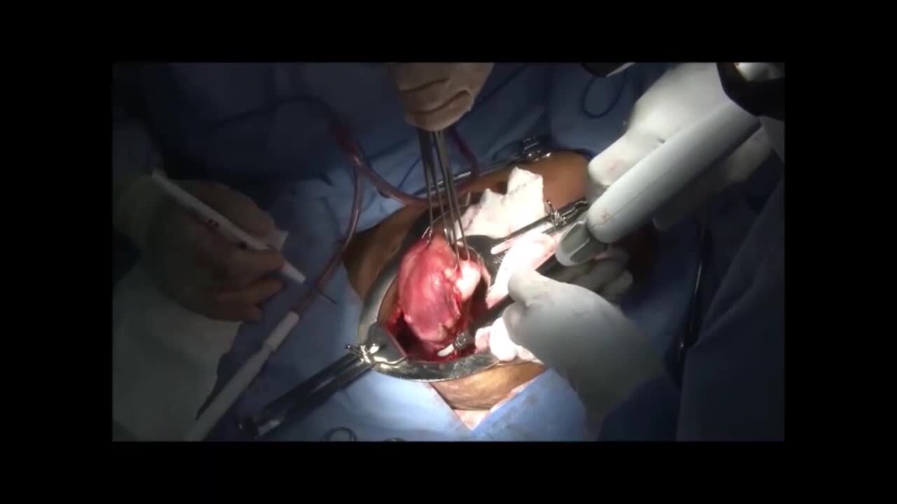 ENSEAL® X1 Large Jaw in TAH