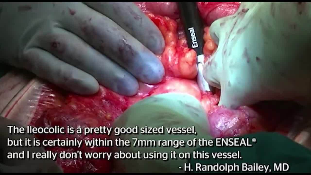 ENSEAL® X1 Large Jaw in Colectomy