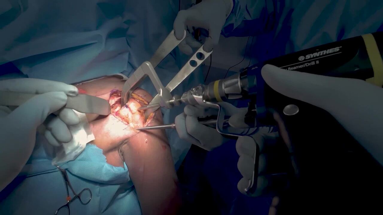 INHANCE INTACT™ Tissue Sparing Technique with Dr. Favorito