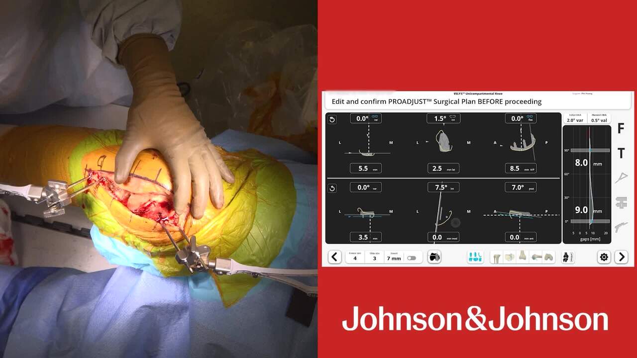 Dr. Huang UKA Robotic-Assisted Procedure