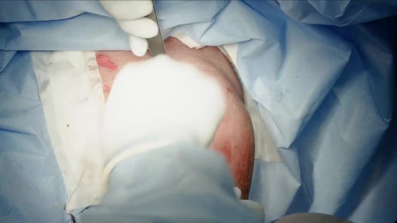 INHANCE INTACT Humeral Head Trialing and Implant Insertion with Dr. Favorito