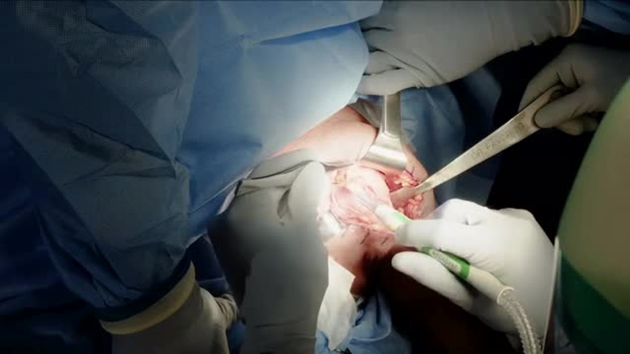 INHANCE INTACT Subscapularis Sparing Exposure for Anatomic TSA with Dr. Favorito