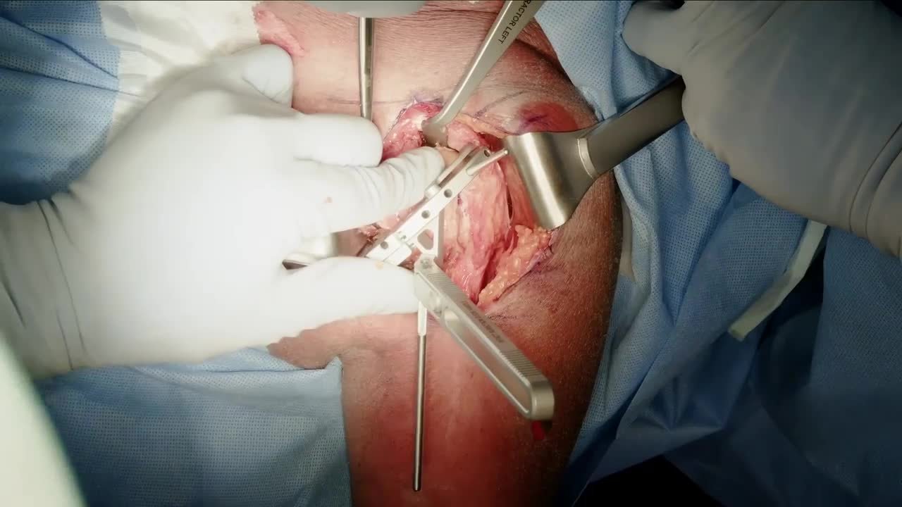 INHANCE INTACT Humeral Resection for Anatomic TSA with Dr. Favorito