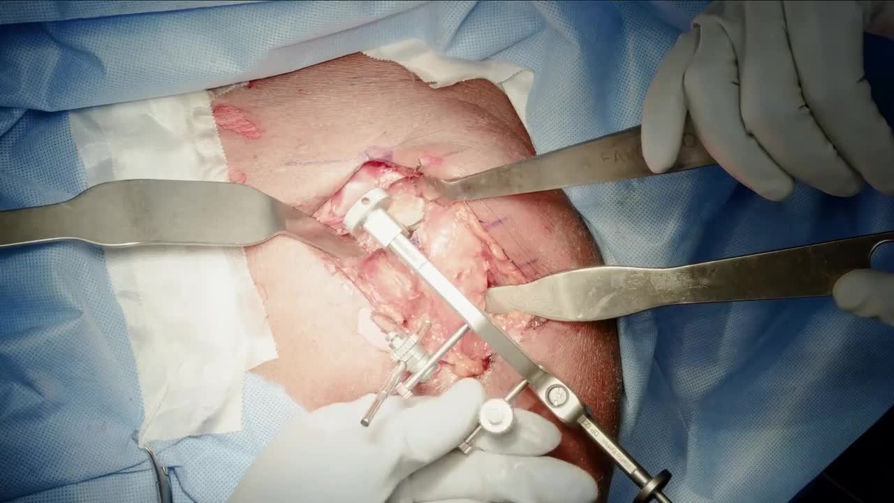 INHANCE INTACT Humeral Preparation for Anatomic TSA with Dr. Favorito