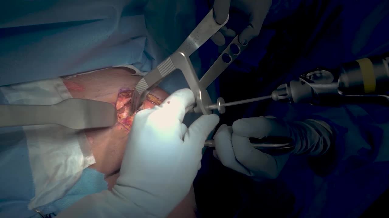 INHANCE INTACT Glenoid Preparation and Implant Placement for Anatomic TSA with Dr. Favorito
