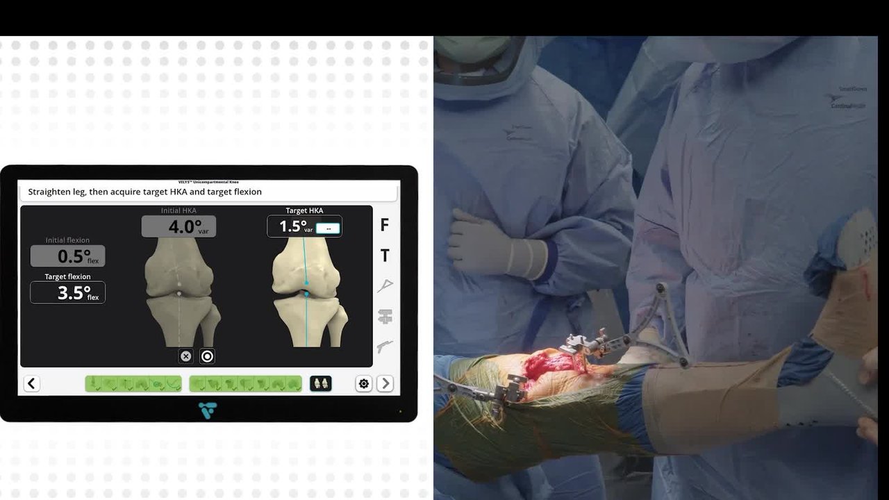 Dr. Nunley UKA Robotic-Assisted Procedure