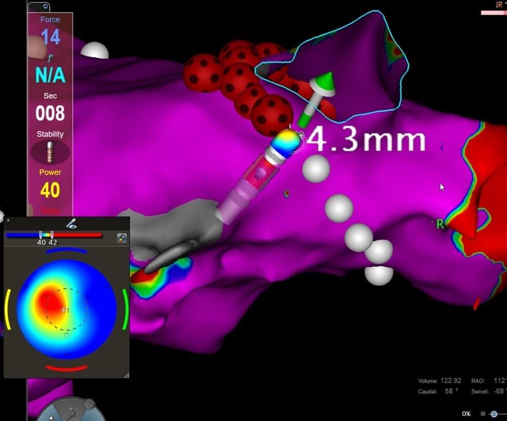 Système de cartographie Biosense Webster avec cathéter d'ablation QDOT Micro®