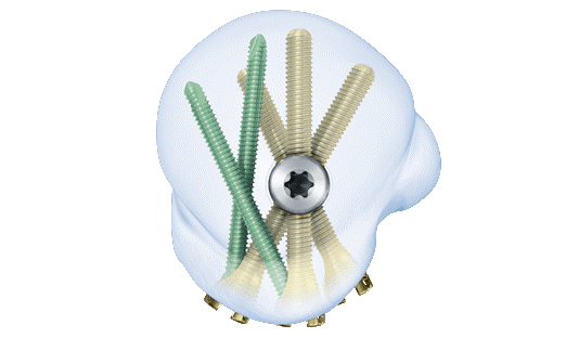 MultiLoc Humeral Nailing System 