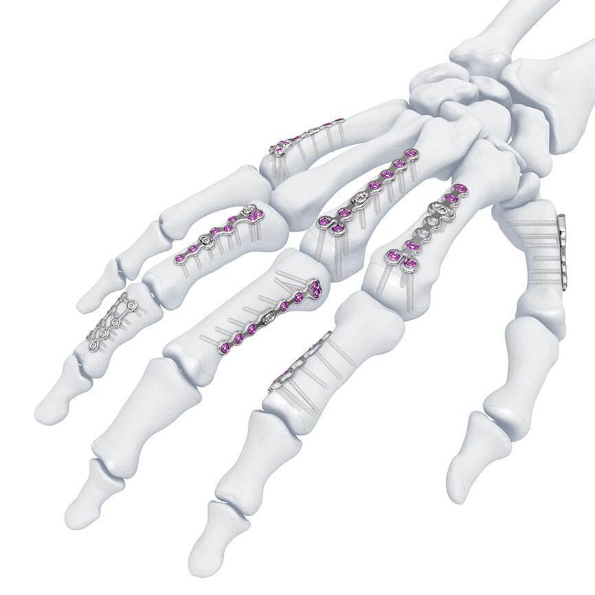 Variable Angle Locking Hand System