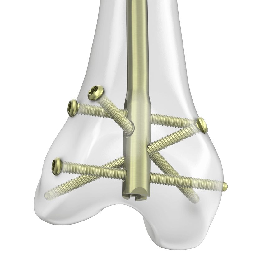 RFN-ADVANCED™ Retrograde Femoral Nailing System | DePuy Synthes