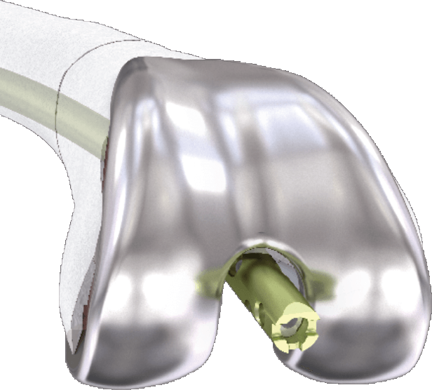 RFN-ADVANCED™ Retrograde Femoral Nailing System | DePuy Synthes