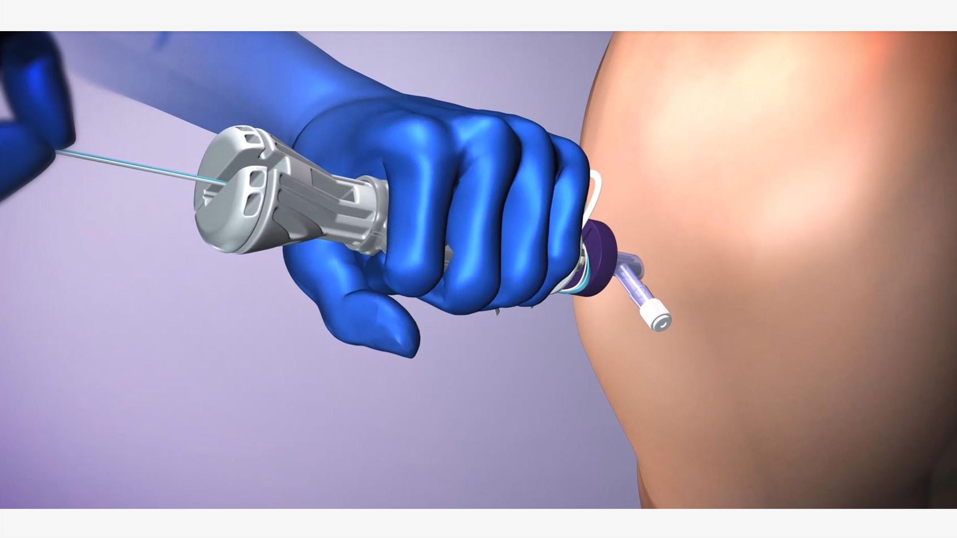 Rotator Cuff Repair | DePuy Synthes