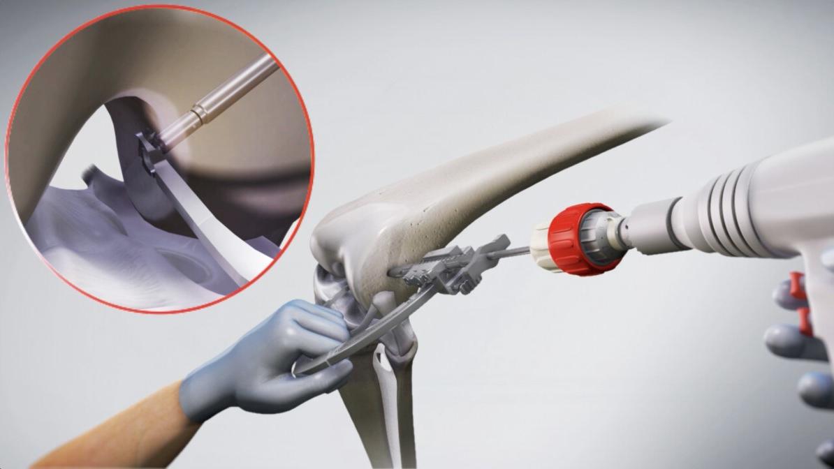 TWISTR™ Retrograde Reamer and Cruciate+ Instruments | DePuy Synthes | J ...