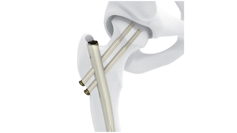 Hip & Knee Fracture | DePuy Synthes