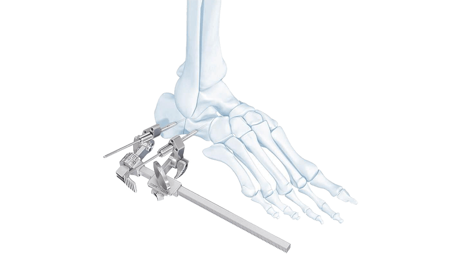 Orthopaedic Foot Systems being used together in bones of human foot 