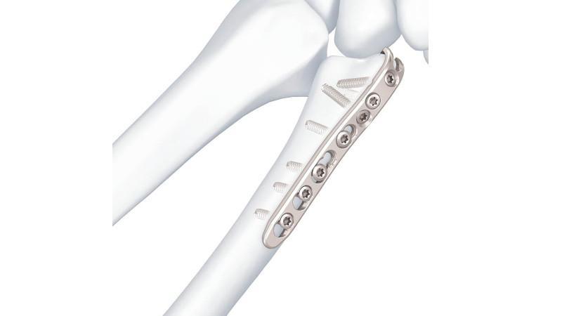 Distal ulna plate attached to ulna
