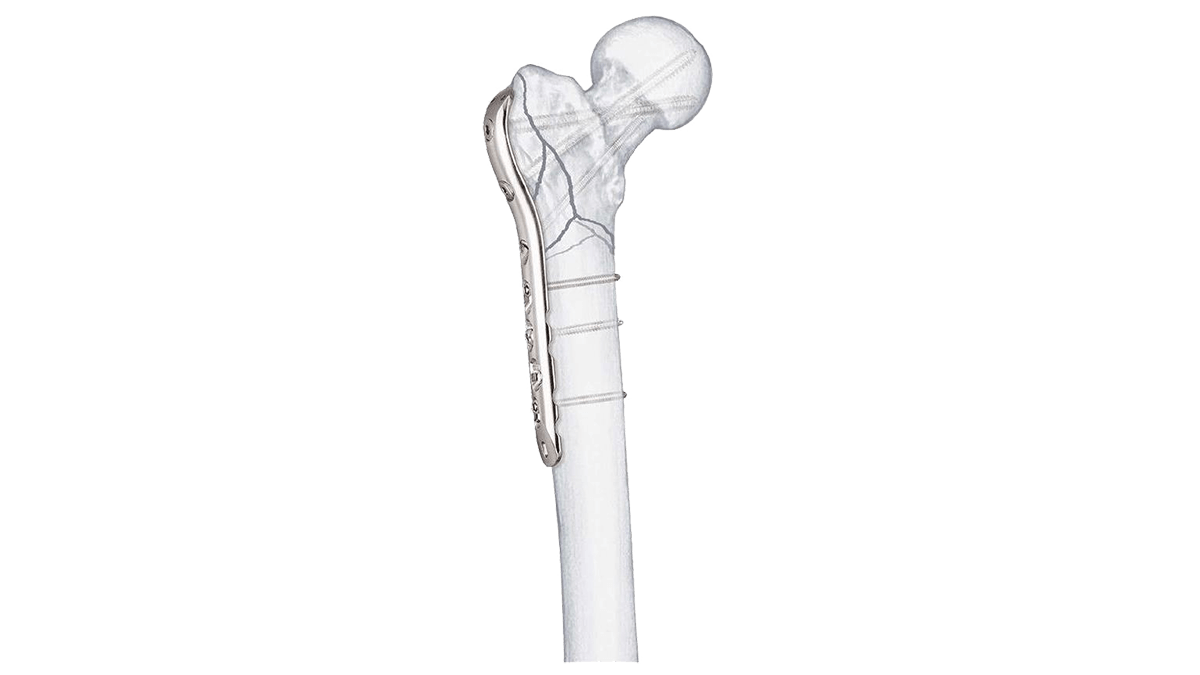 LCP Proximal Femur Plate attached to femur