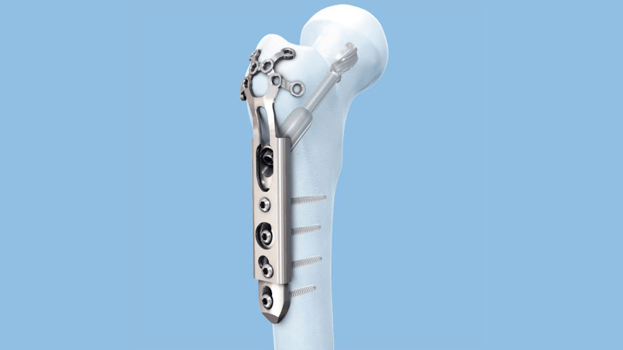 The Universal Locking Trochanter Stabilization Plate affixed to femoral bone 