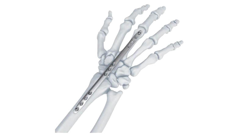 Wrist spanning plate attached to skeletal bones