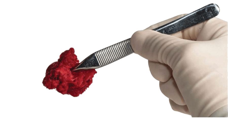 Image of PliaFX Prime Demineralized Bone Fibers held in surgical tongs by gloved hand