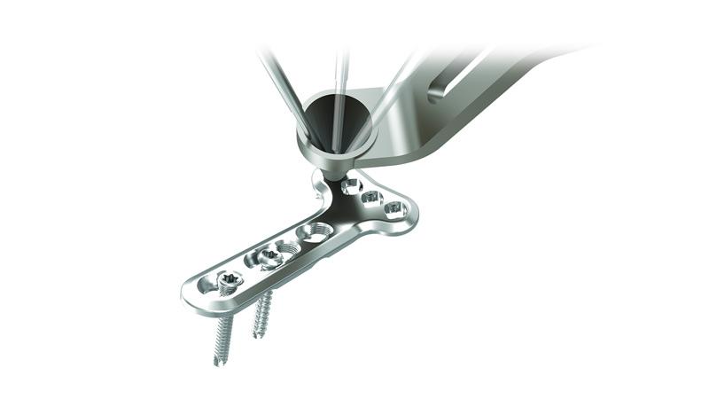 2.4 mm Variable Angle LCP™ Volar Extra-Articular Distal Radius System ...