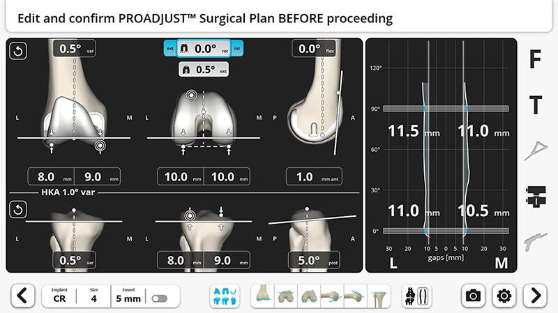 VELYS™ Robotic-Assisted Solution | Products | DePuy Synthes