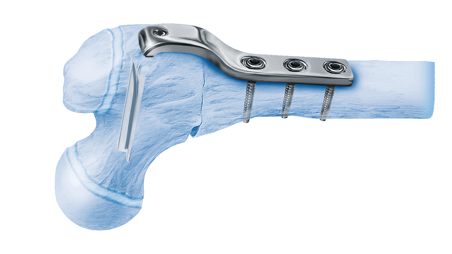 Cannulated Pediatric Osteotomy System shown in bone.