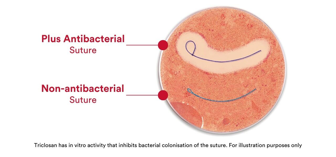 Why every hospital should consider Ethicon Plus Sutures