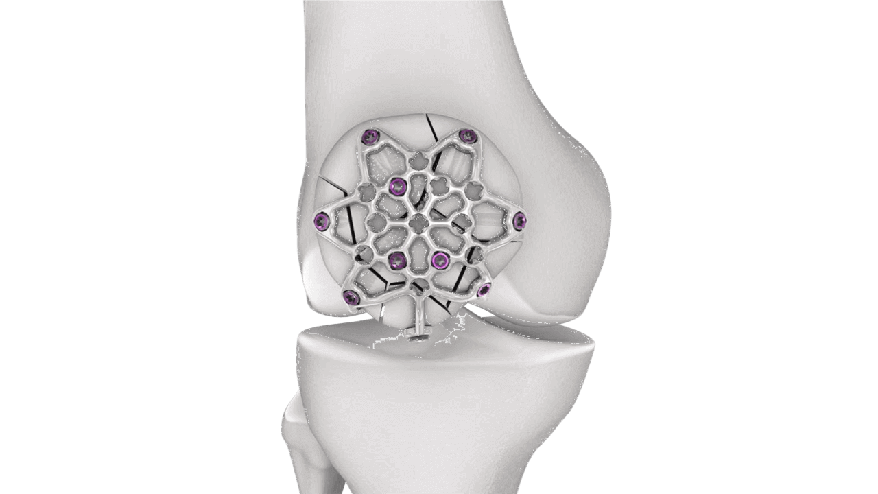Variable Angle Locking Patella Plating System