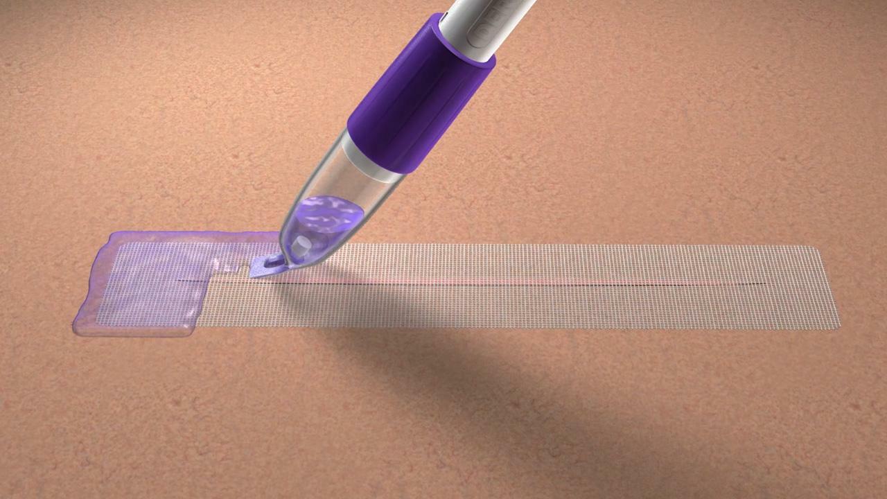 DERMABOND PRINEO Skin Closure System | Ethicon