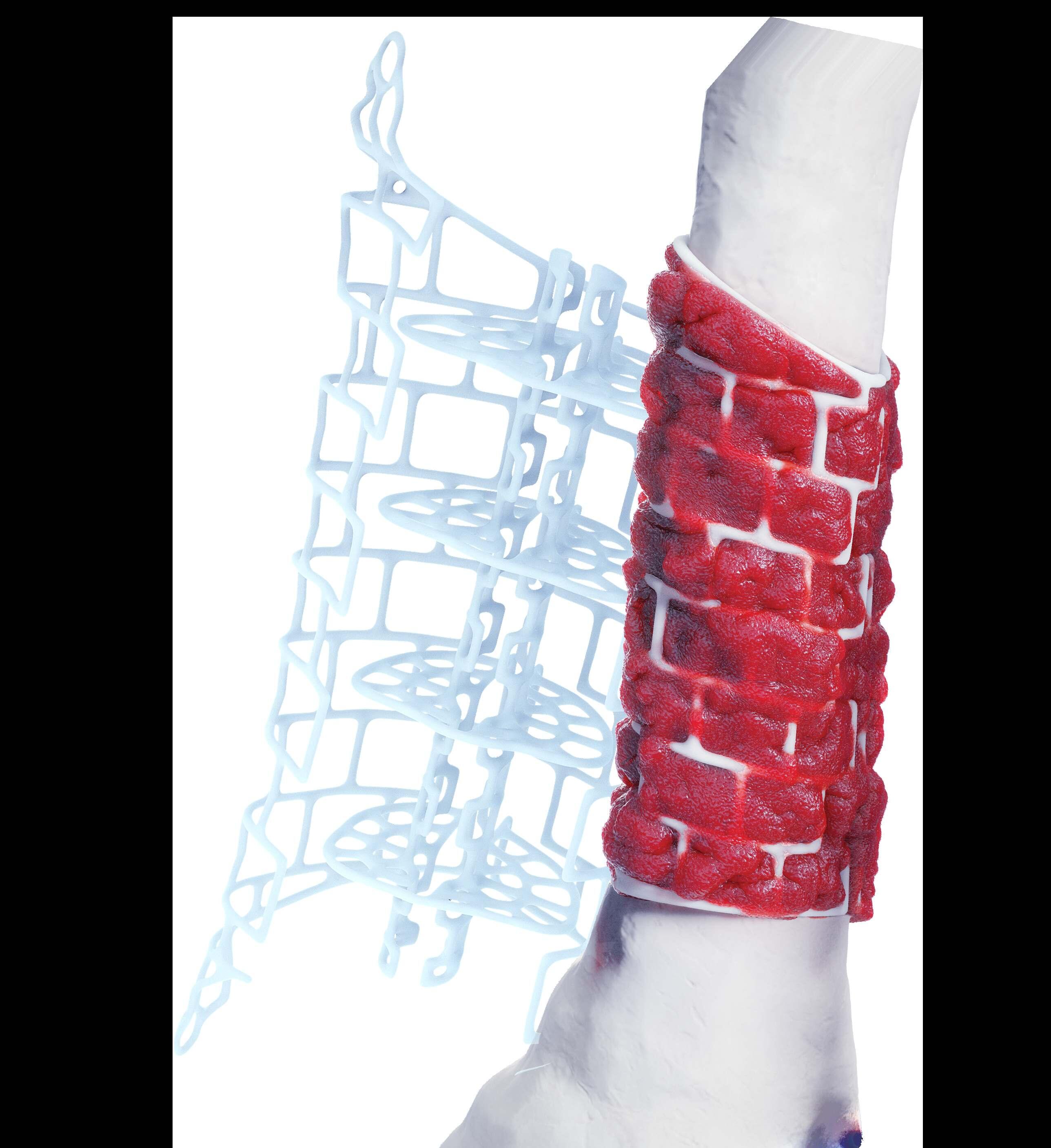 Graft Cage in Tibia 