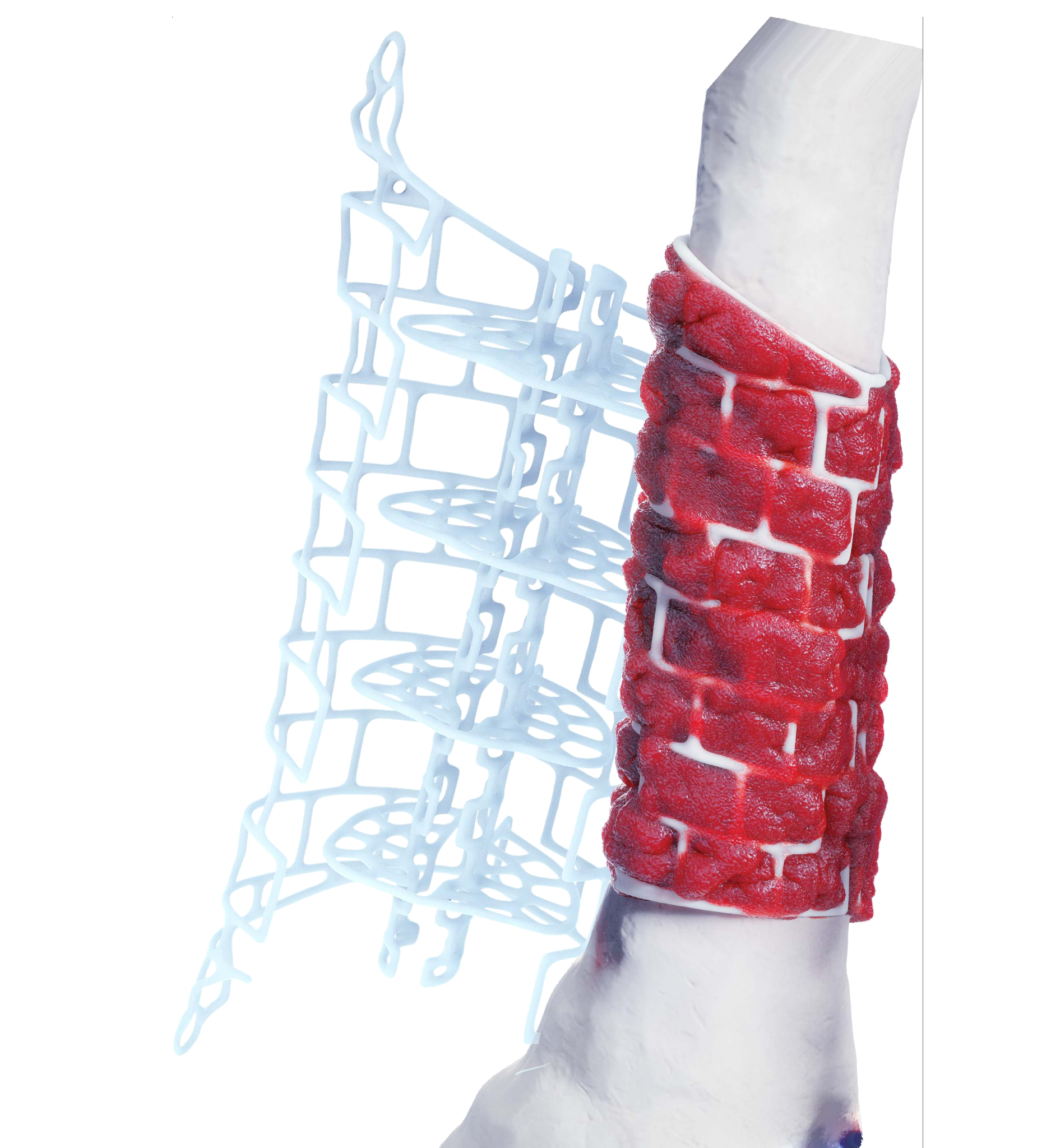 Graft Cage in Tibia  