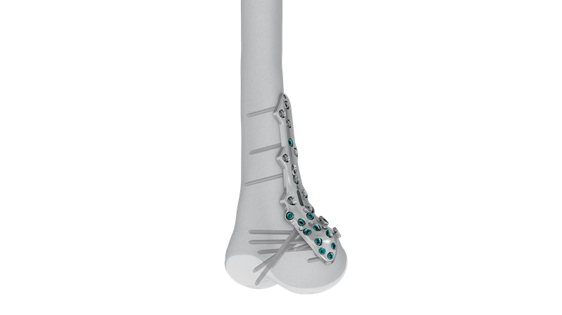 VOLT Medial Distal Femur Plate