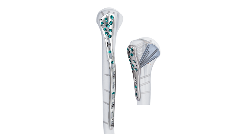 VOLT Proximal Humerus Plate on bone