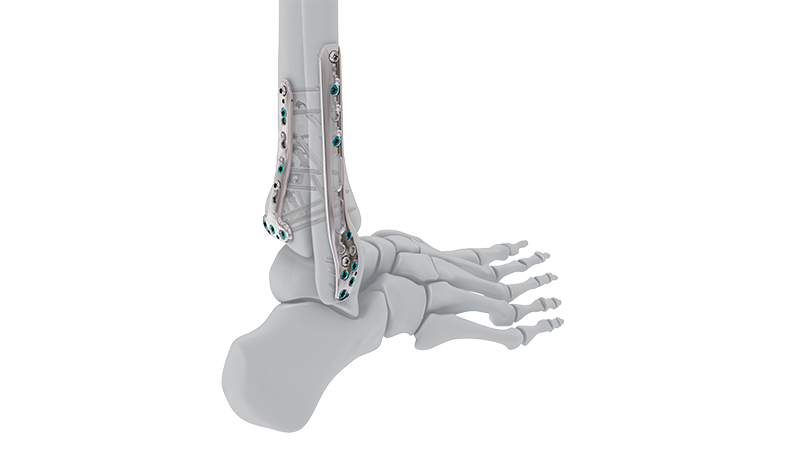 VOLT Ankle Plate