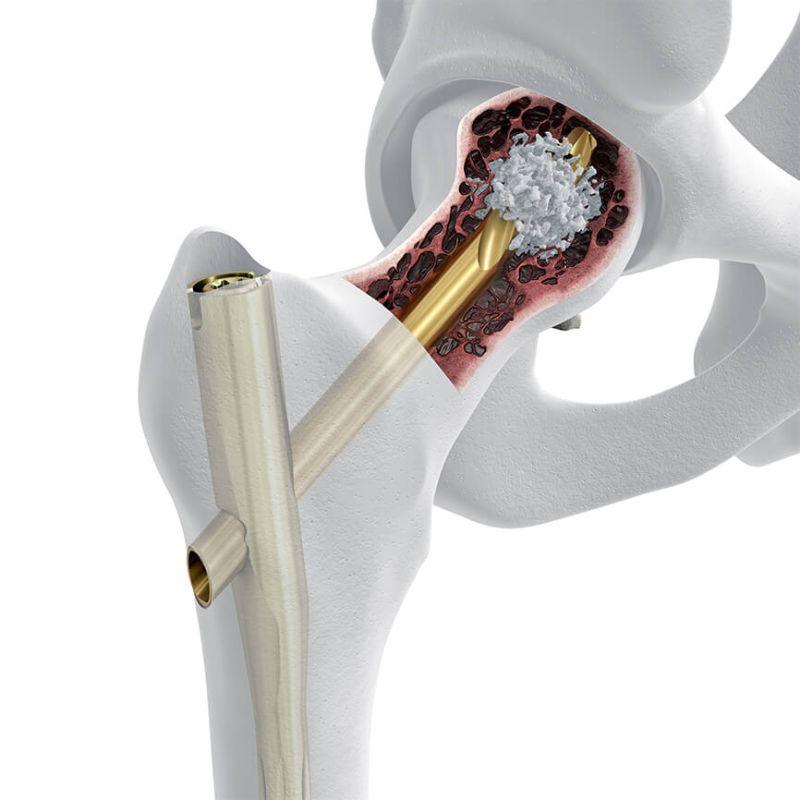 TFN-ADVANCED® Proximal Femoral Nailing System (TFNA)