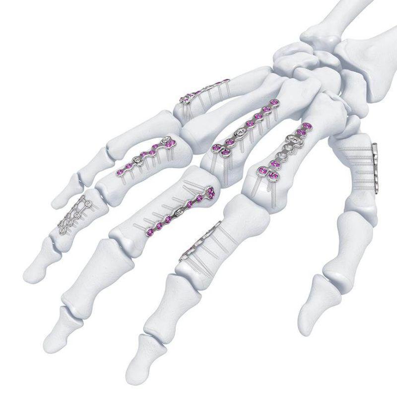 Variable Angle Locking Hand System