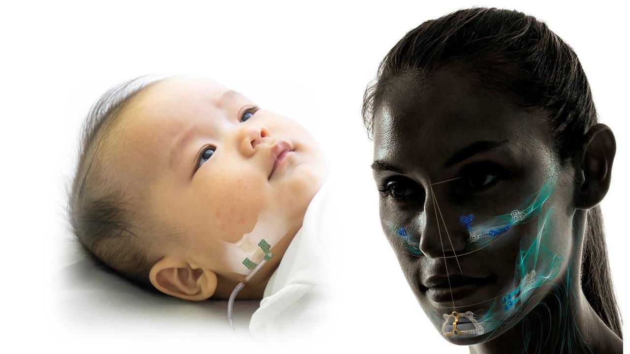 Baby mandible treated with CMF distractor and woman face showing orthognathic implants