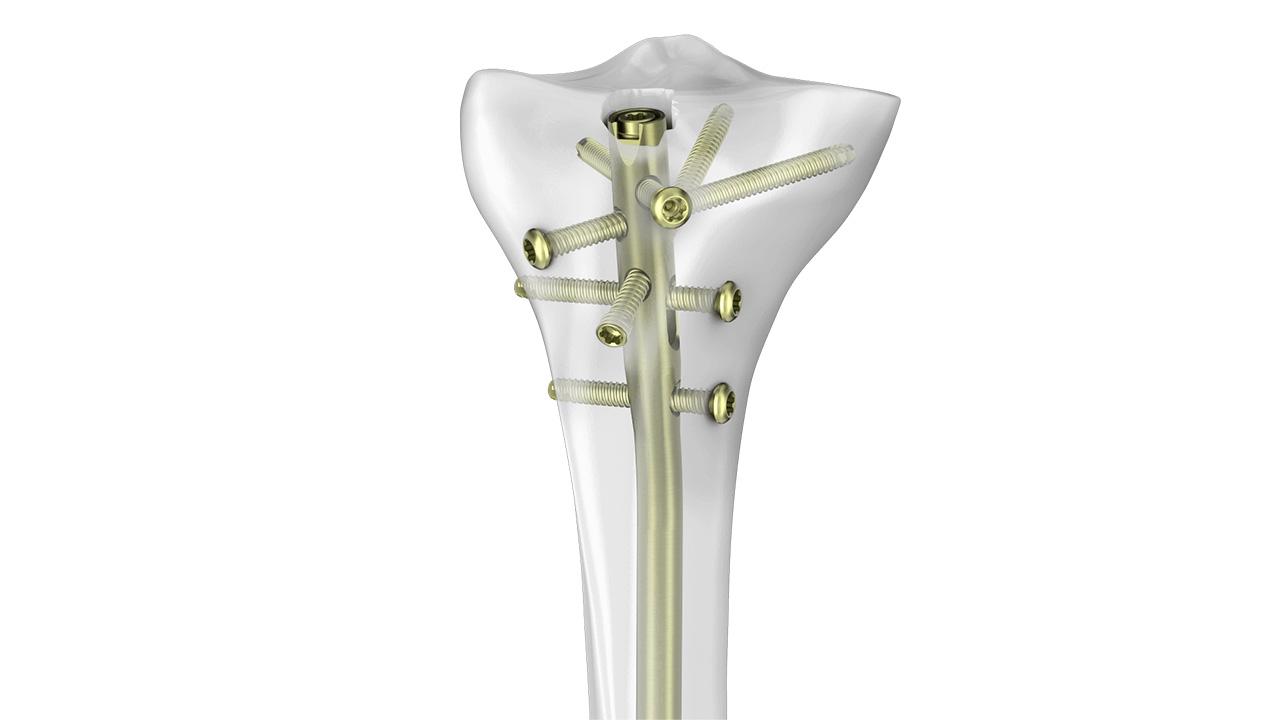 TN advanced tibial