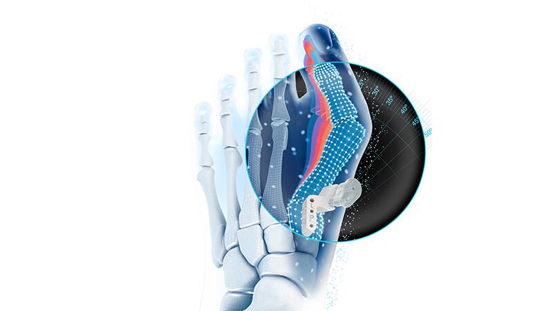 VIRTUGUIDETM AI software bunion correction planning for Lapidus procedures