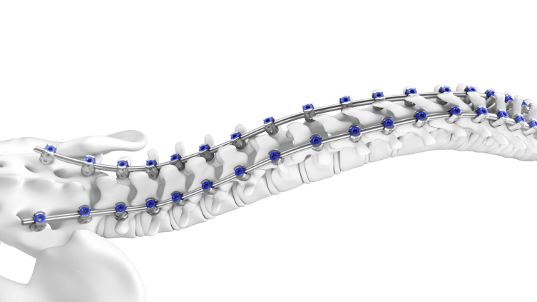 TriALTIS Spine System shown in place in a curved spine