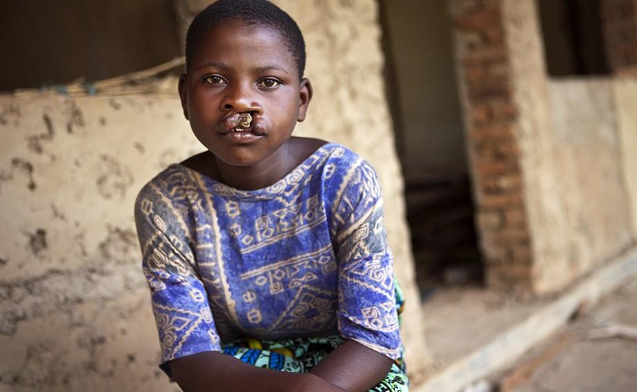 child with facial deformity
