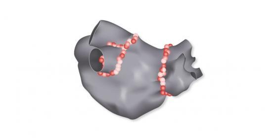 radiofrequency ablation success heart