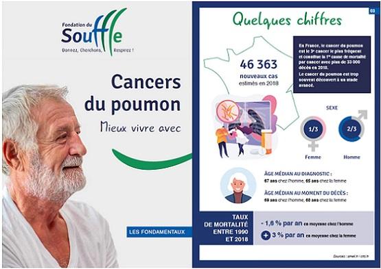Tout savoir sur les cancers du poumon