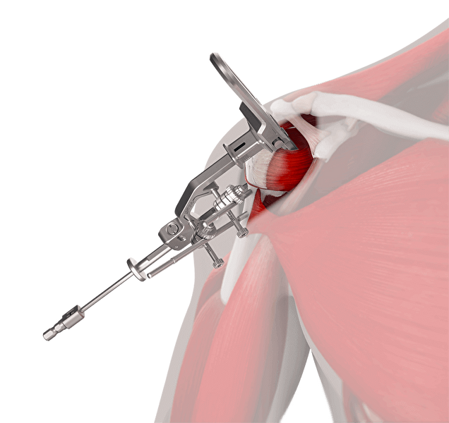 INHANCE INTACT™ Tissue-Sparing Approach